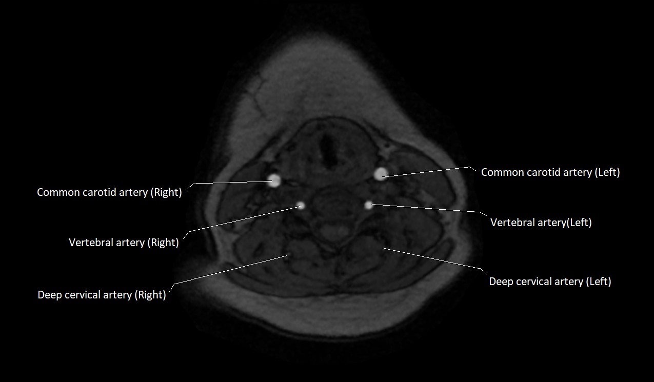 Carotid artery anatomy axial 3T image 39.jpg